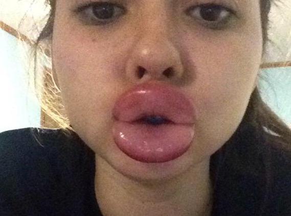 Kylie Jenner Lip Challenge (Zdroj: Class of Kulture)
