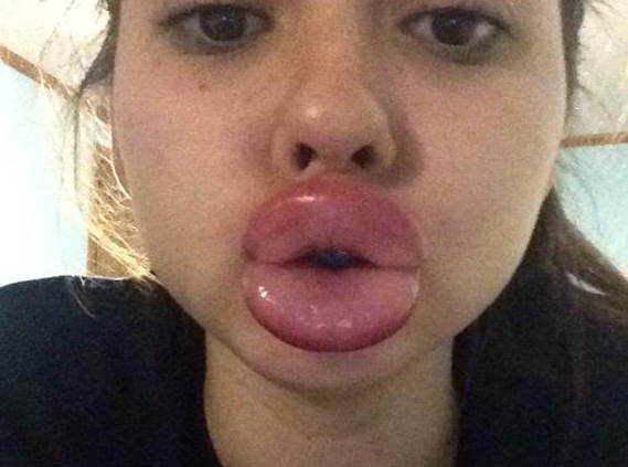 Kylie Jenner Lip Challenge (Zdroj: Class of Kulture) Kylie Jenner Lip Challenge (Zdroj: Class of Kulture)
